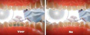 Tandsteen voor en na behandeling