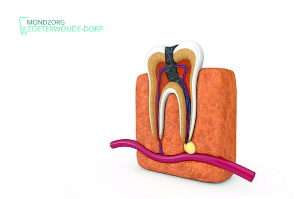 Zenuwpijn kies? Symptomen, pijnstiller & wat kun je er tegen doen?