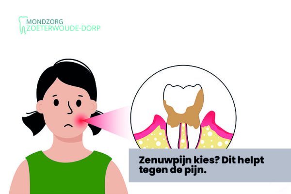 Zenuwpijn kies? Symptomen, pijnstiller & wat kun je er tegen doen?